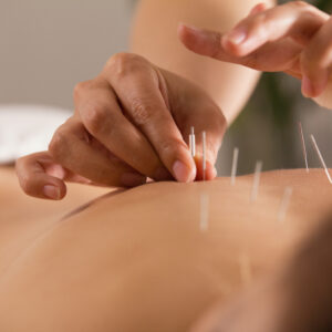 A close-up of a person receiving acupuncture, with a practitioners hands inserting thin needles into the skin on their back. The setting appears calm and professional.